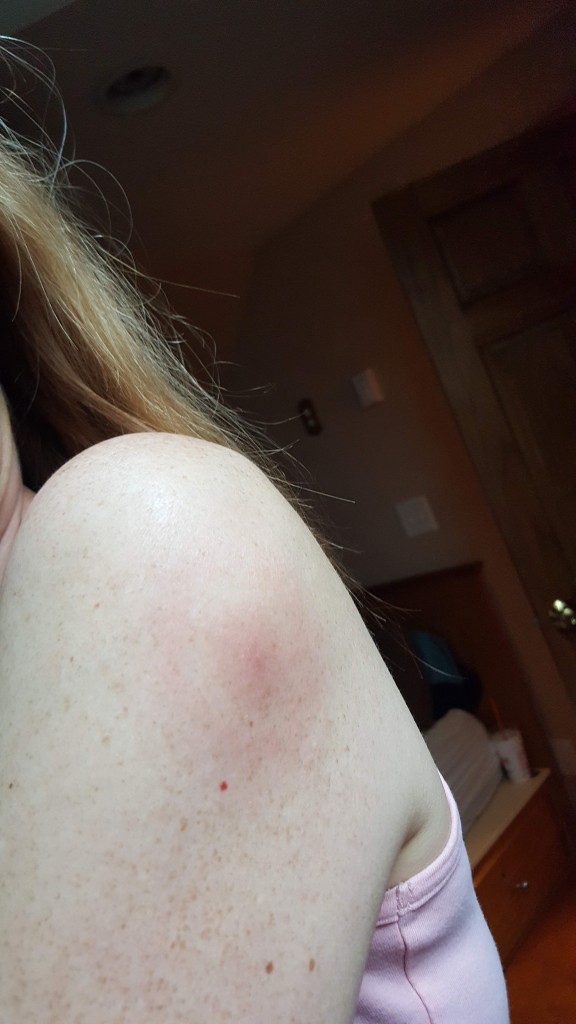 Lyme disease bullseye rash